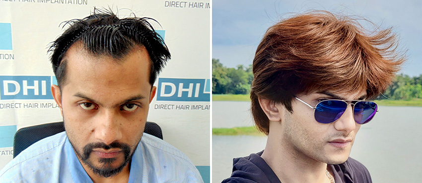 DHI before & after hair transplant results